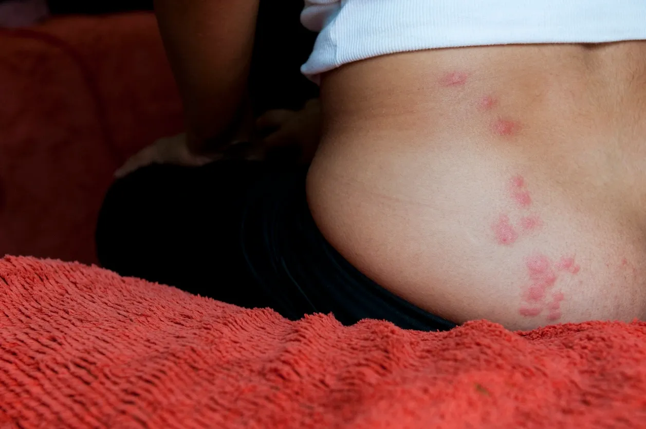 piqures de punaises de lit.webp
